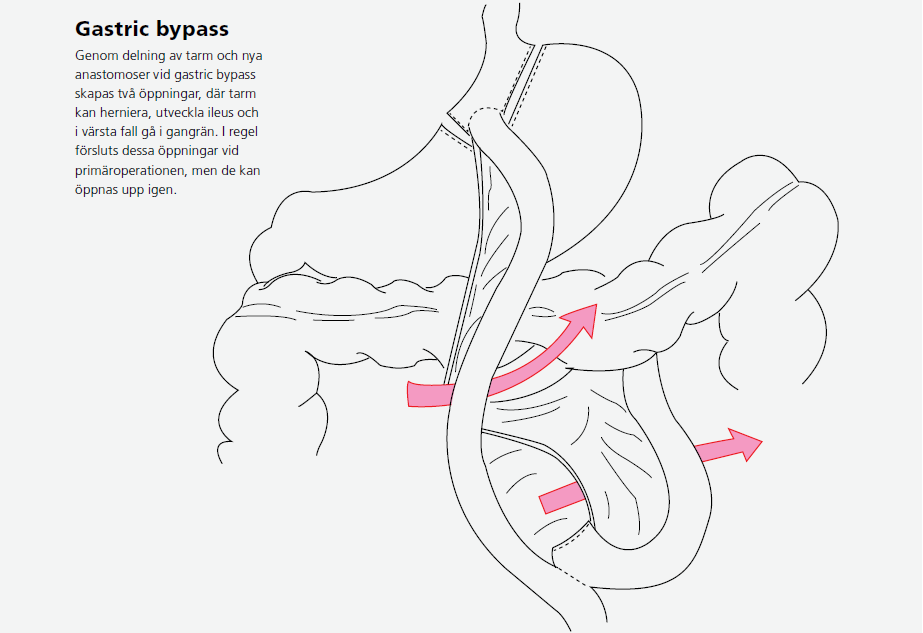 Bild på gastric bypass.